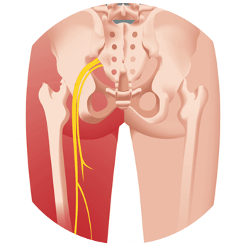 sciatica