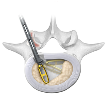 Endoscopic Discectomy Home