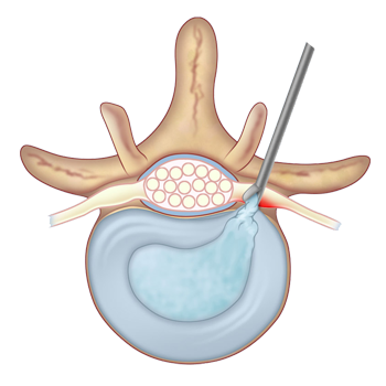 Micro Discectomy Home