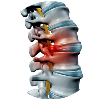 Radiculopathy