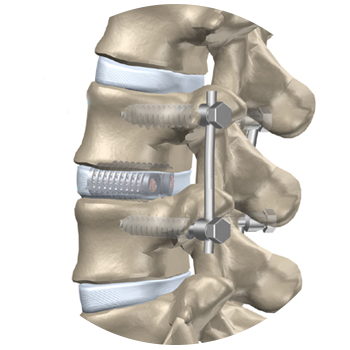 Scoliosis Surgery Home