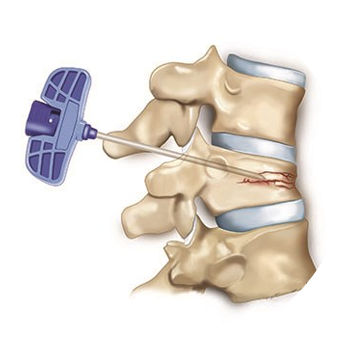 Vertebroplasty treatment icon Home