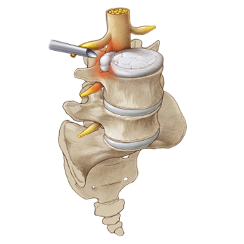 endoscopic spine surgery Home