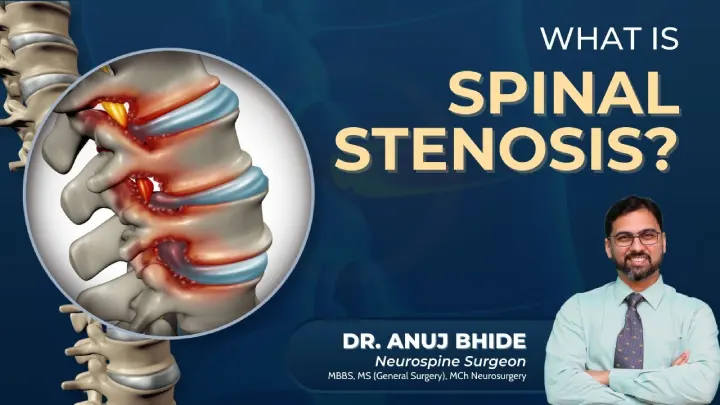 what is spinal stenosis Spinal Stenosis