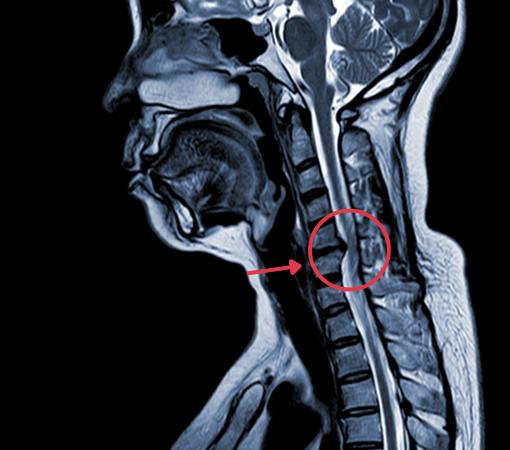 Cervical myelopathy