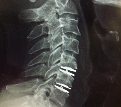 Disc replacement surgery in Mumbai - Synapse Spine