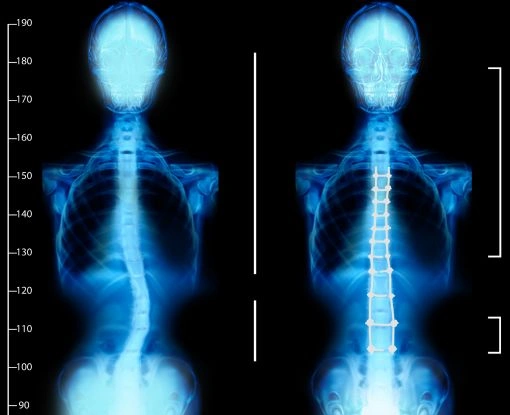 SCOLIOSIS SURGERY