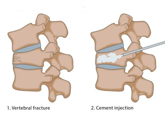 Verteroplasty surgery