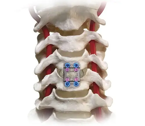 Anterior cervical discectomy and fusion