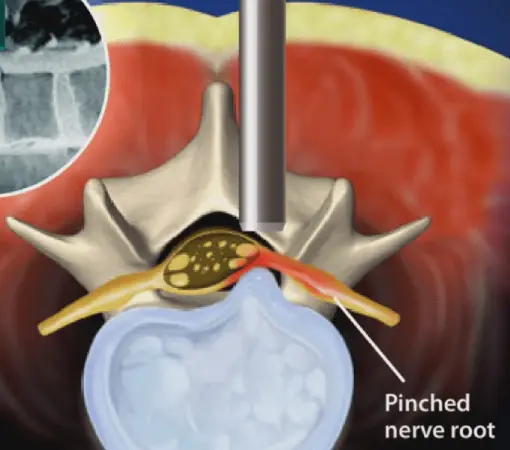 endoscopic discectomy surgery treatment