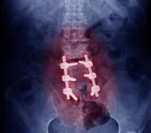 lumbar spinal fusion