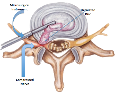 Microdiscectomy