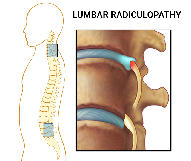 Radiculopathy