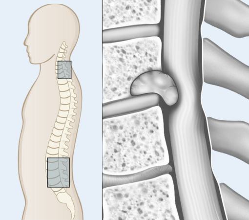 spinal cord injury