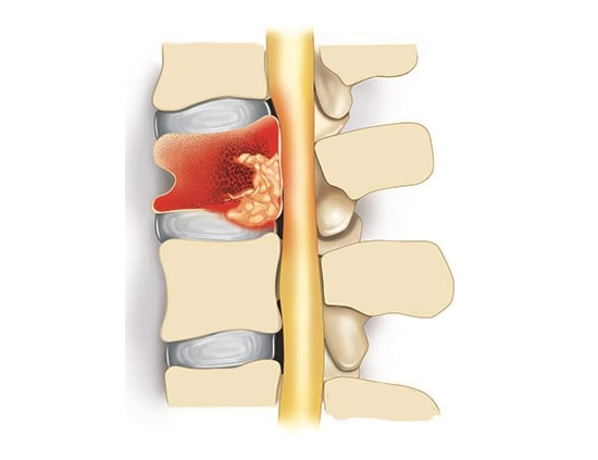 spine infections