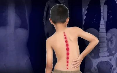 Recognizing Scoliosis In Your Teen