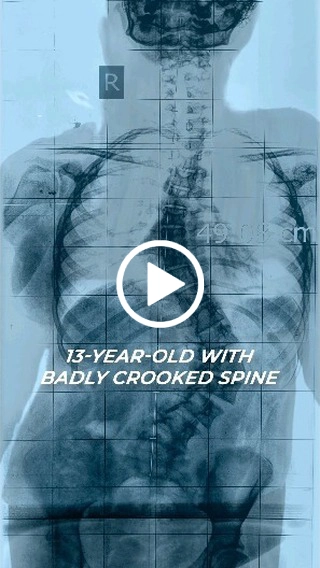13 year old with badly crooked spine Scoliosis surgery