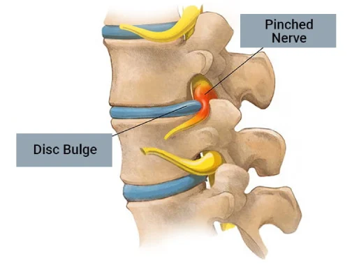 Can Physiotherapy Cure L4–L5 Disc Bulge?