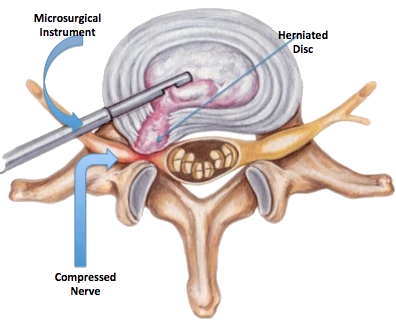 Microdiscectomy