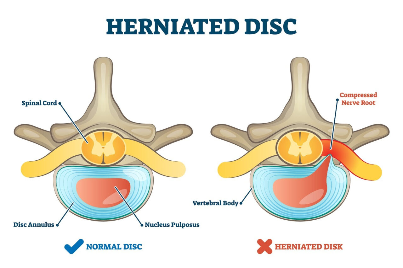 Slipped Disc vs. Bulging Disc: A Patient’s Guide to the 